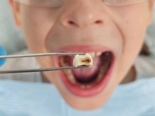 Best Emergency Treatment for Toothache in Fanning Springs, FL